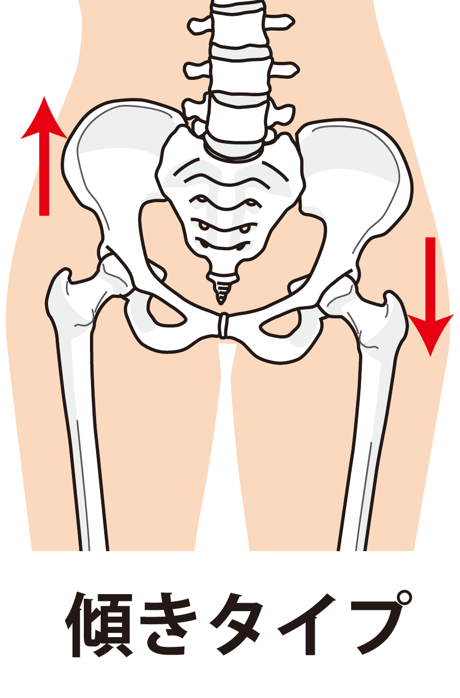 ゆがんだ骨盤のイラスト